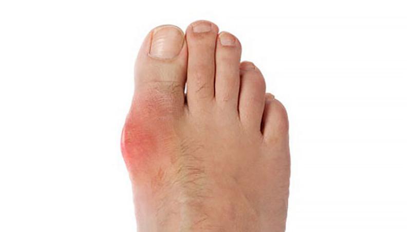 Ayurvedic Treatment for Gout