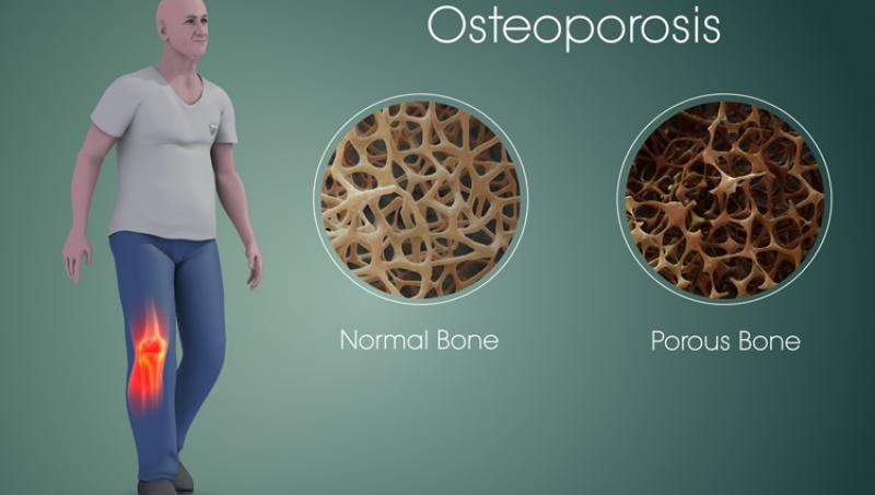 Osteoporosis