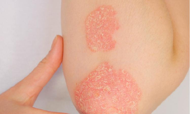 Ayurvedic Treatment for Psoriasis